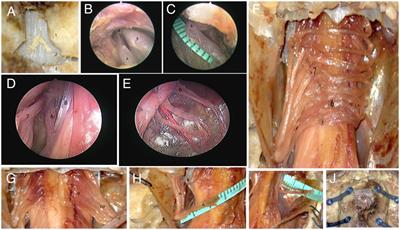 Anatomical study of single incision contralateral C7 nerve transfer through subdural pathway